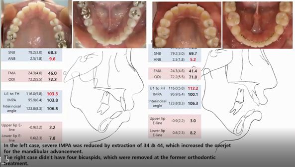 Ca bên trái: điều trị kết hợp phẫu thuật. Ca bên phải: nắn chỉnh răng đơn thuần